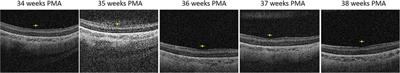 Preterm infant retinal OCT markers of perinatal health and retinopathy of prematurity